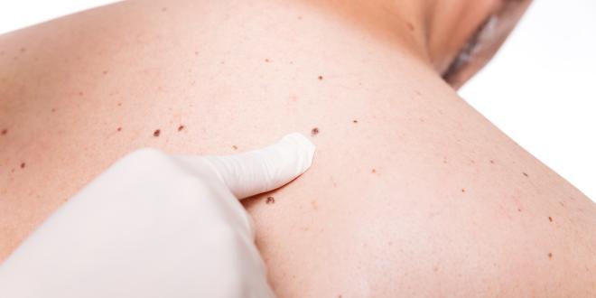 Neurokutane Melanose Melanose vom neurokutanen Typ