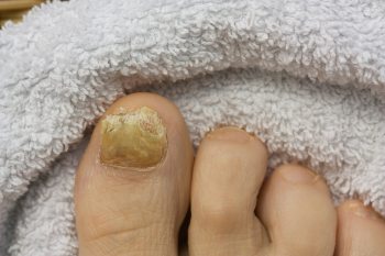 Nagelpilz Canesten Nagelpilz