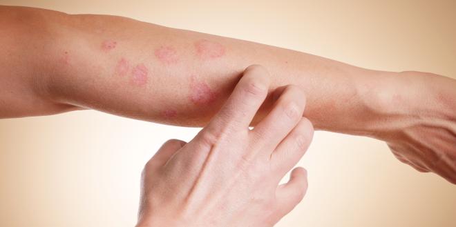 Ansteckend kleienpilzflechte Pityriasis versicolor