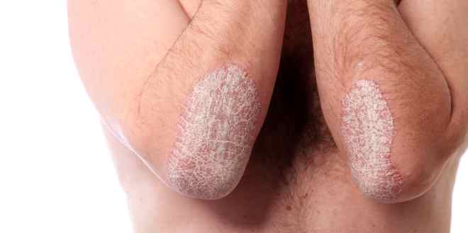 Fumaderm®