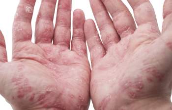 Small Itchy Eczema Bumps on Hands, Fingers, and Elbow