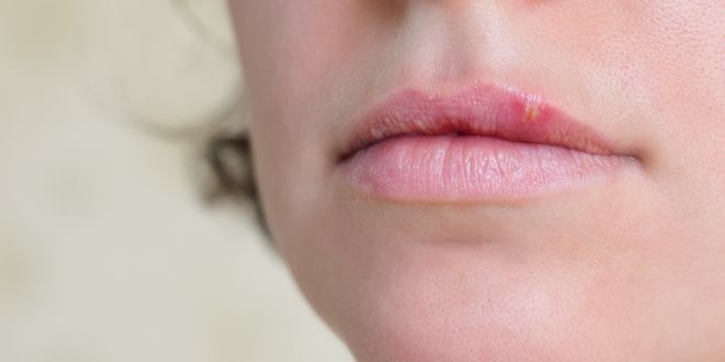 Dauer von Lippenherpes