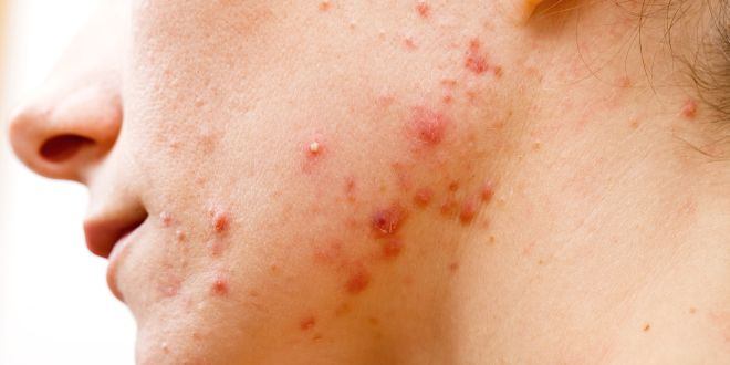 Impetigo contagiosa