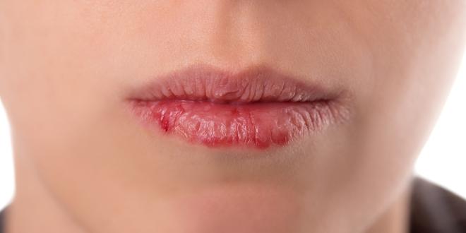 Rand entzündete lippen roter Lippenleckekzem