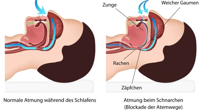 Schnarchen