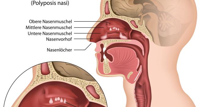 Nasenpolypen