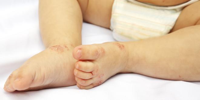 Erkrankungen rund um die Haut beim Baby