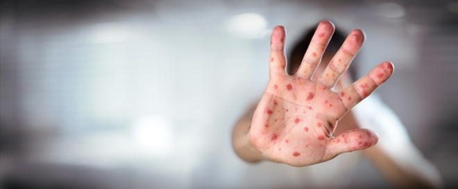 Symptome von Masern Hand, rote Flecken, Handinnenfläche, Masern