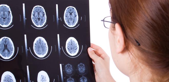 Radiologin beurteilt MRT mit Hirnblutung