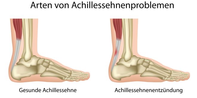 Abbildung einer Achillessehnenentzündung