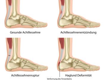 Probleme der Achillessehne