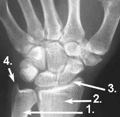 was bedeutet abriss des processus styloideus ulnae was bedeutet abriss des processus styloideus ulnae