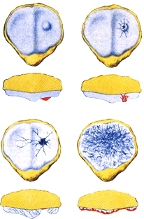 Retropatellararthrose