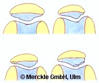 Kniescheibe Kniescheibe