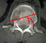 Wirbelbruch Diagnose