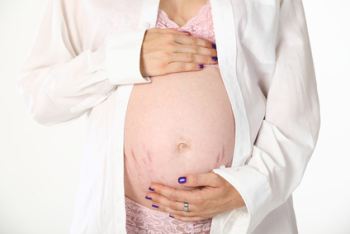 Schwangerschaft Bandscheibenvorfall