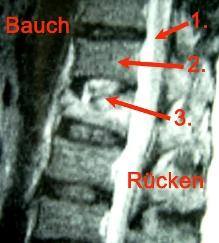 Spondylodiszitis seitlich MRT seitlich Spondylodiszitis
