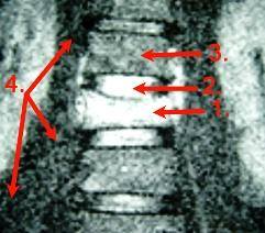 Spondylodiszitis Abbildung MRT Spondylodiszitis