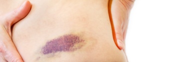 Blauer Fleck durch Sturz Sturzinduzierter blauer Fleck