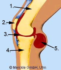 Abbildung Kniegelenk mit Bakerzyste