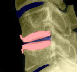 Bandscheibenprothese der HWS