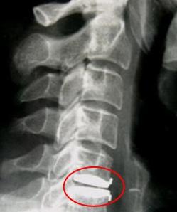 Röntgenbild einer Bandscheibenprothese