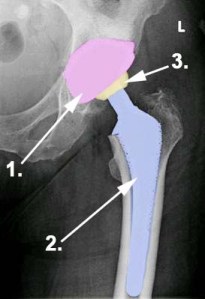 Röntgenbild einer Hüftprothese (TEP)