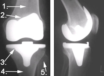 Röntgenbild mit Knieprothese