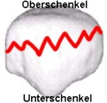 Kniescheibenbruch quer Kniescheibenbruch quer