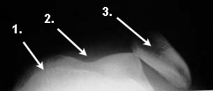 Röntgenbild Kniescheibenluxation