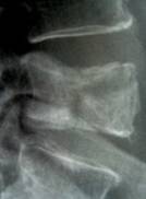 Röntgenbild Wirbelbruch