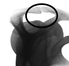 Röntgenbild Schulter nach Dekompression