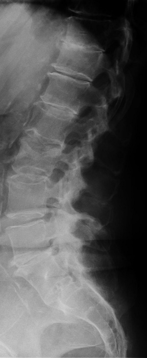 Röntgenbild der LWS mit Wirbelkörperfraktur