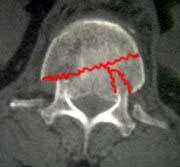 CT eines Wirbelbruchs