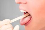 Test für Zungenkrebs