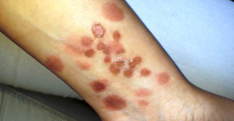 Ausschlag hiv Skin rash