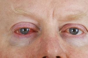 Gürtelrose am Auge