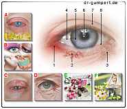 Ekzem am Auge