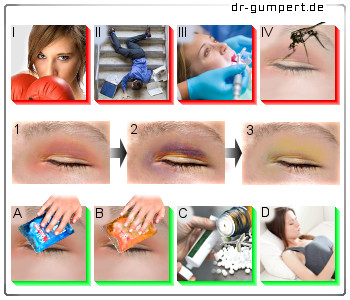 Abbildung Blaues Auge Abbildung Blaues Auge