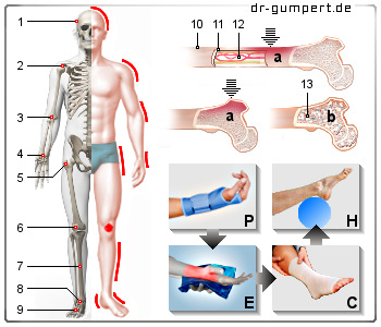 Abbildung bone bruise Abbildung bone bruise