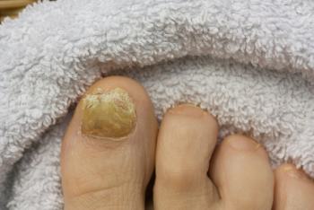 Fußnagelpliz Fußnagelpliz