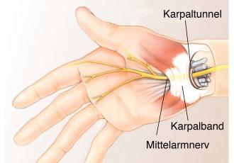 Karpaltunnel Hand Medianus Karpaltunnel Hand Medianus