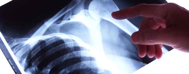 Das älteste Verfahren der Radiologie ist die Bildgebung mittels Röntgenstrahlen. Dabei wird elektromagnetische Strahlung durch den Körper "geschossen" und je nach Dichte des Gewebes unterschiedlich absorbiert.