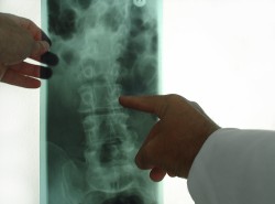 Epidurale Infiltration