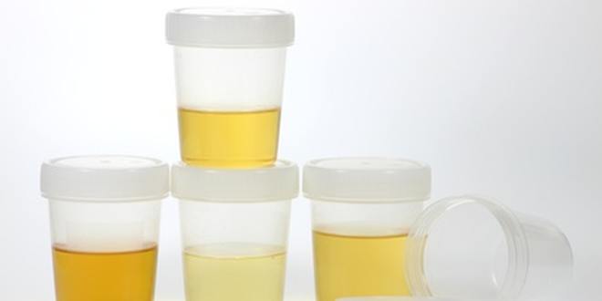 Urinuntersuchung Untersuchung des Urins