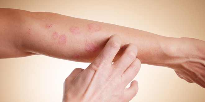 allergische Reaktion am Arm allergische Reaktion am Arm