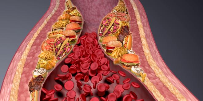 Arteriosklerose Arterienverkalkung