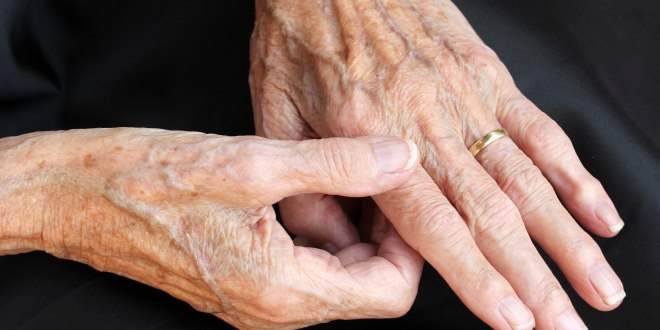 Therapie des Gichtanfalles Gichtanfall Hand