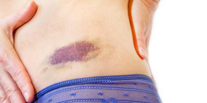 Blauer Fleck