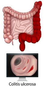 Colitis ulcerosa